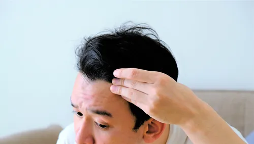 AGA(男性型脱毛症)治療